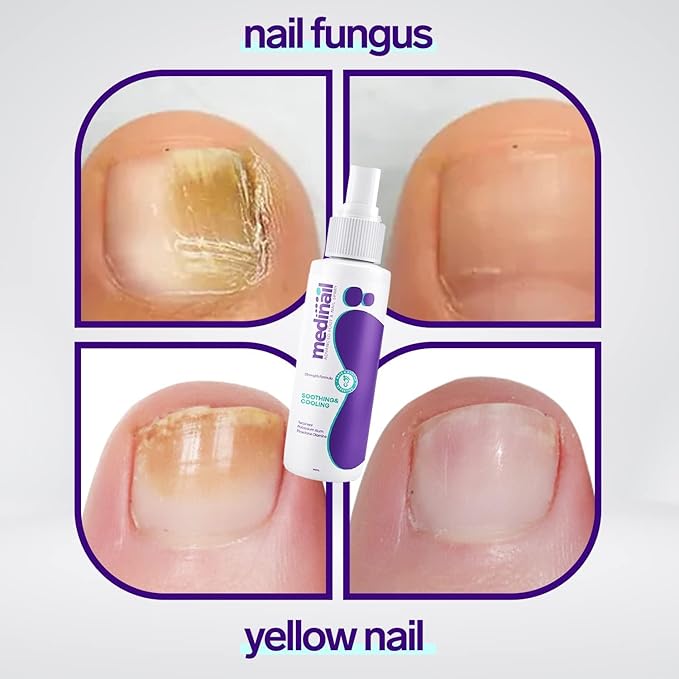 Jaysuin Nail Fungus Spray